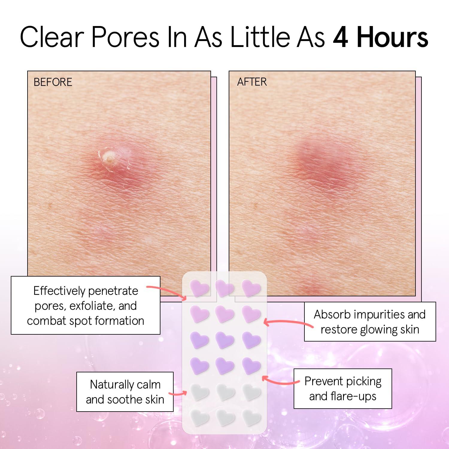imagegrace ampamp stella Award Winning Pore Strip Pimple Patches for Face Hydrocolloid Acne Patches Absorbs Zits Reduces Redness Cute Patches DermatologistTested Vegan Multishape 72 Count216 Count Pack of 1