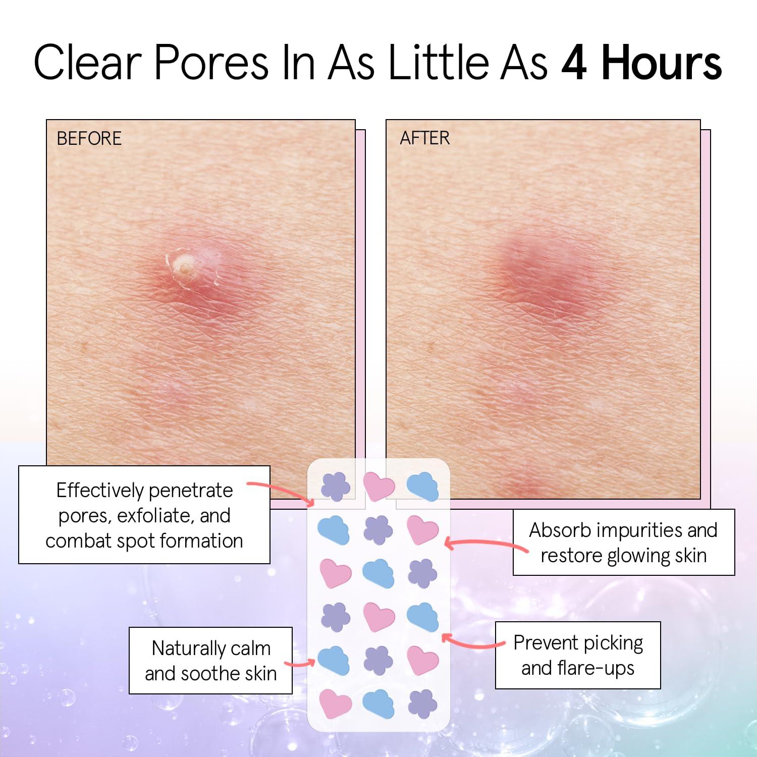 imagegrace ampamp stella Award Winning Pore Strip Pimple Patches for Face Hydrocolloid Acne Patches Absorbs Zits Reduces Redness Cute Patches DermatologistTested Vegan Multishape 72 Count216 Count Pack of 1