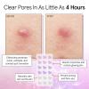 grace & stella Award Winning Pore Strip – Pimple Patches for Face – Hydrocolloid Acne Patches – Absorbs Zits, Reduces Redness – Cute Patches Dermatologist-Tested, Vegan (Multishape, 72 Count)(Pack of 36)