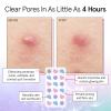 grace & stella Award Winning Pore Strip – Pimple Patches for Face – Hydrocolloid Acne Patches – Absorbs Zits, Reduces Redness – Cute Patches Dermatologist-Tested, Vegan (Multishape, 72 Count)(1 Count (pack of 36))